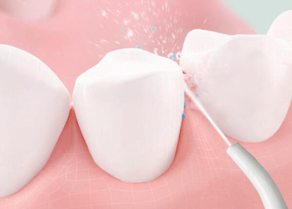 洗牙后用洗牙器好還是電動(dòng)牙刷？口腔清潔工具這樣選！