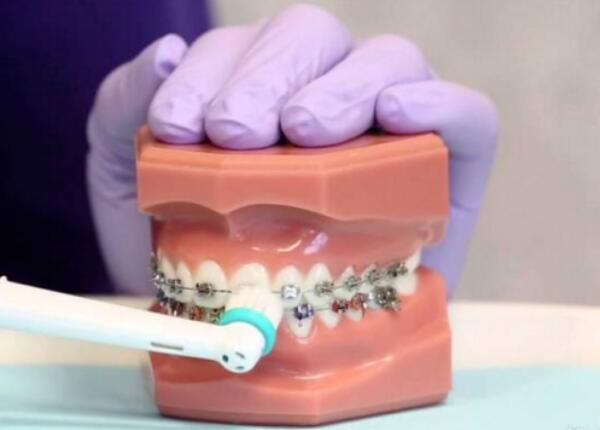 卸了牙套能用電動(dòng)牙刷嗎？答案就在這篇文章